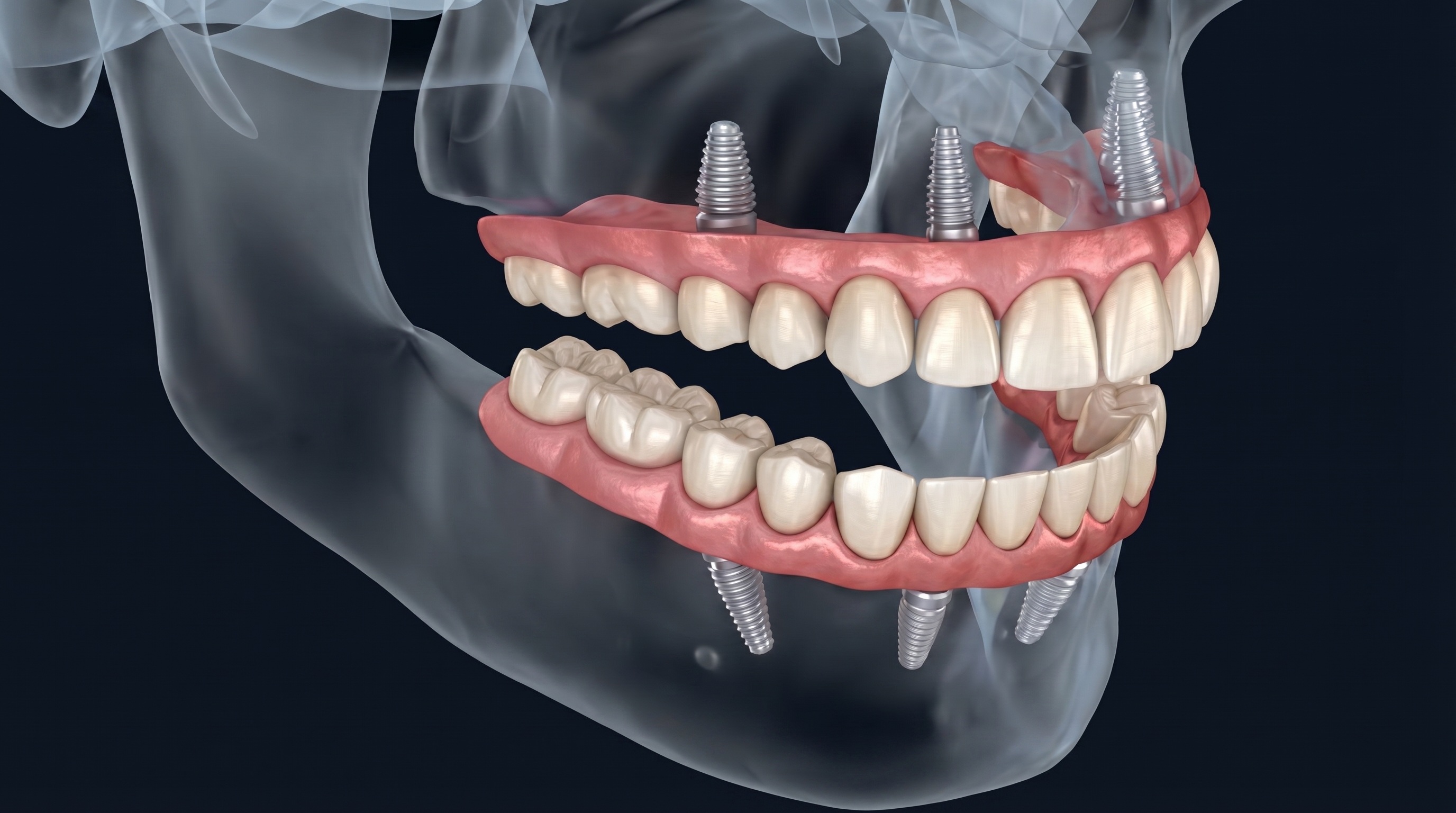 Prótesis Protocolo sobre Implantes — Odontolatina Hernandarias