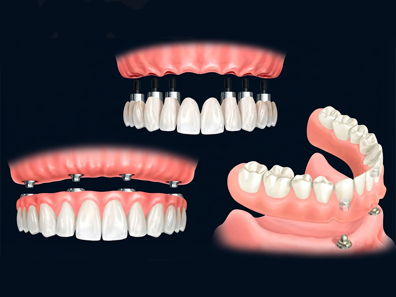 Prótesis protocolo sobre implantes — All-on-4, All-on-6 y carga inmediata